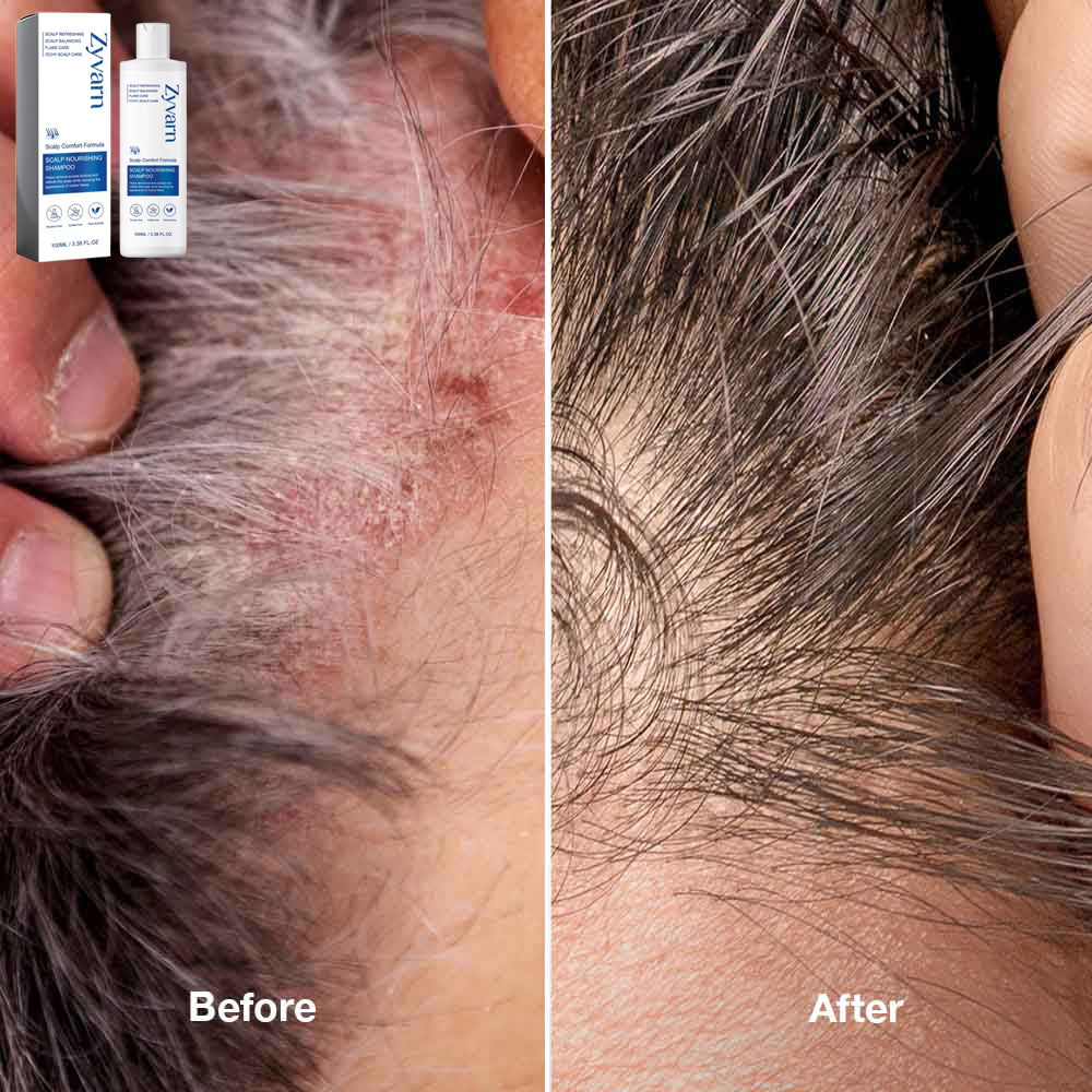 Seborrheic Dermatitis Shampoo Zyvarn