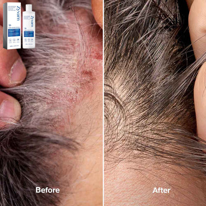 Seborrheic Dermatitis Shampoo Zyvarn