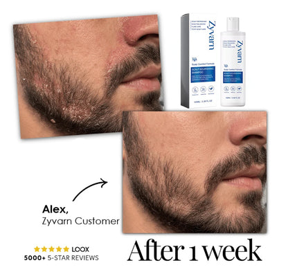Seborrheic Dermatitis Shampoo Zyvarn